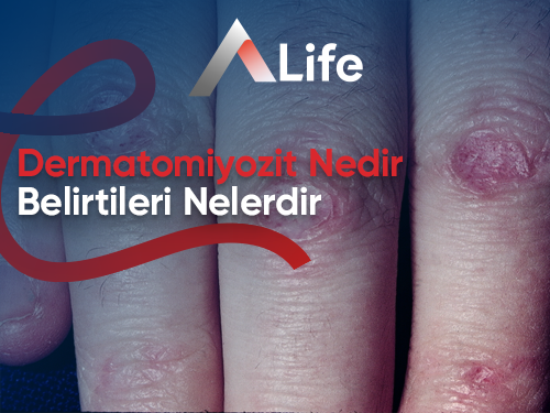 Dermatomiyozit Nedir? Belirtileri Nelerdir?